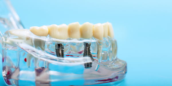 Implant dentaire Senlis