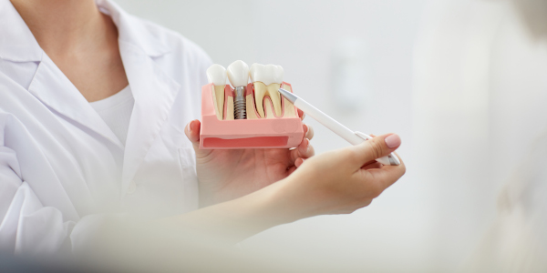 Implants dentaires Senlis